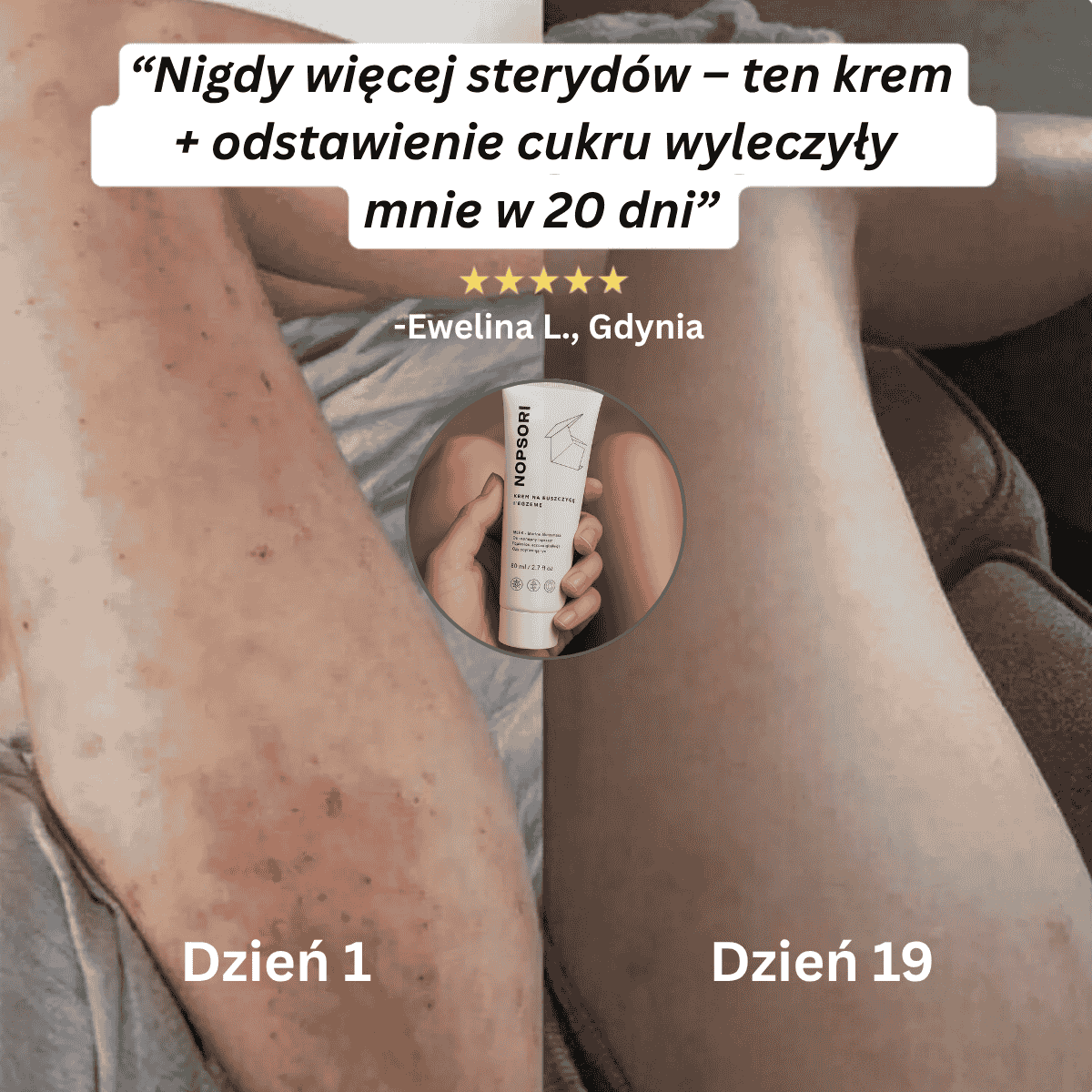 Nopsori- Natychmiastowe ukojenie dla skóry z łuszczycą i egzemą