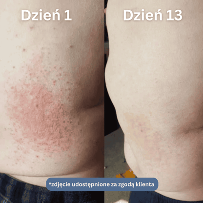 Nopsori- Natychmiastowe ukojenie dla skóry z łuszczycą i egzemą